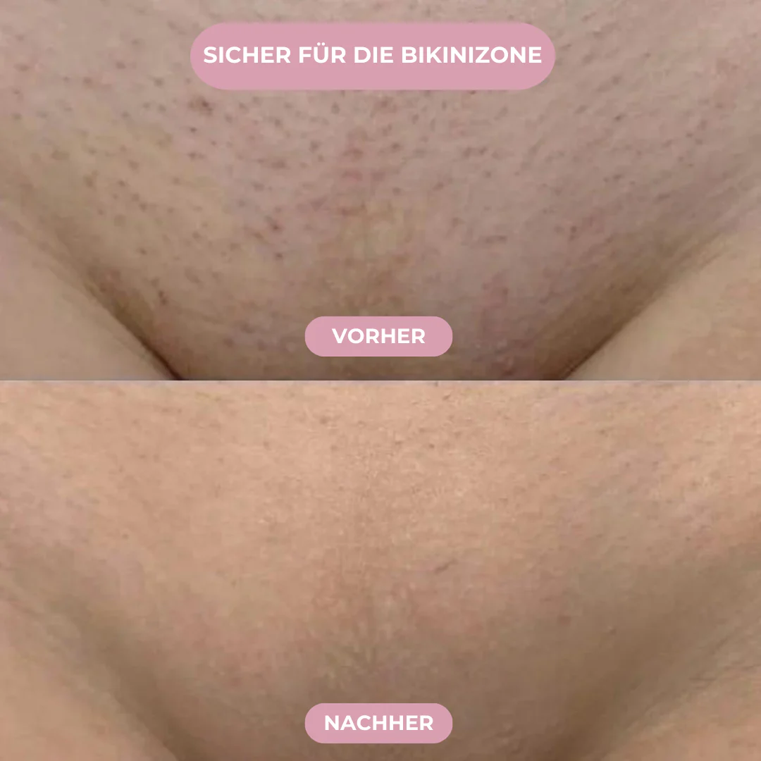 FLOAMMI - IPL Hair Removal